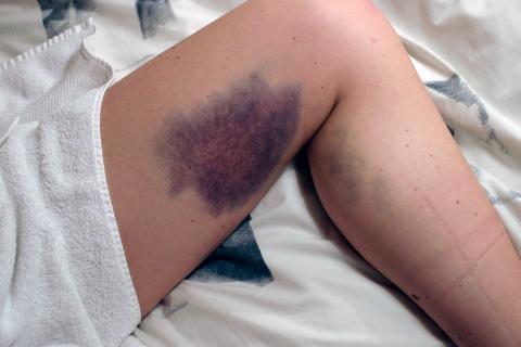 Bruise. The Dutch for "bruise" is "kneuzing". Bruise. The Dutch for "bruise" is "kneuzing".