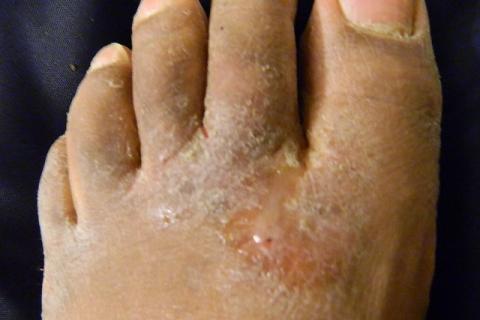 Athlete’s foot. The Thai for "athlete’s foot" is "น้ำกัดเท้า".