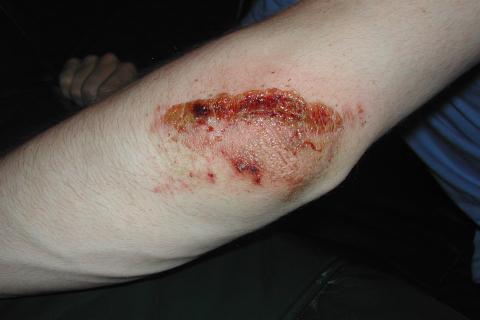 A wound on elbow. The Thai for "a wound on elbow" is "แผลบนศอก". A wound on elbow. The Thai for "a wound on elbow" is "แผลบนศอก".