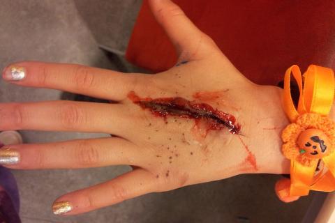 A wound on the back of the hand. The Thai for "a wound on the back of the hand" is "แผลบนหลังมือ". A wound on the back of the hand. The Thai for "a wound on the back of the hand" is "แผลบนหลังมือ".