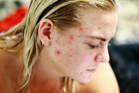 Many pimples on her face. The Thai for "many pimples on her face" is "สิวจำนวนมากบนใบหน้าเธอ". Many pimples on her face. The Thai for "many pimples on her face" is "สิวจำนวนมากบนใบหน้าเธอ".