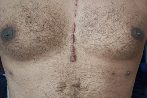 A scar on his chest. The Thai for "a scar on his chest" is "แผลเป็นบนหน้าอกของเขา". A scar on his chest. The Thai for "a scar on his chest" is "แผลเป็นบนหน้าอกของเขา".