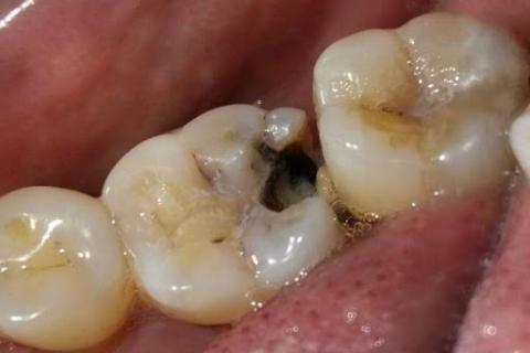 Tooth decay. The Thai for "tooth decay" is "ฟันผุ". Tooth decay. The Thai for "tooth decay" is "ฟันผุ".