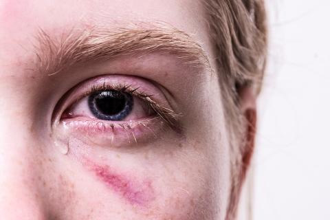 A bruise on a woman’s face. The Thai for "a bruise on a woman’s face" is "รอยช้ำบนหน้าผู้หญิง". A bruise on a woman’s face. The Thai for "a bruise on a woman’s face" is "รอยช้ำบนหน้าผู้หญิง".
